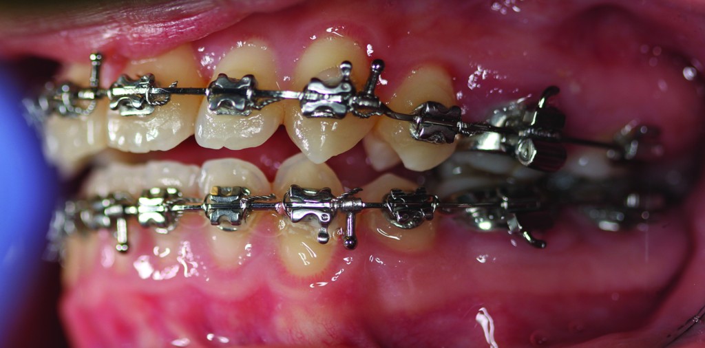 Craniofacial Orthodontics At Texas Children's North Austin Campus